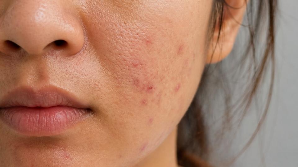 those with meth face may have visible sores.